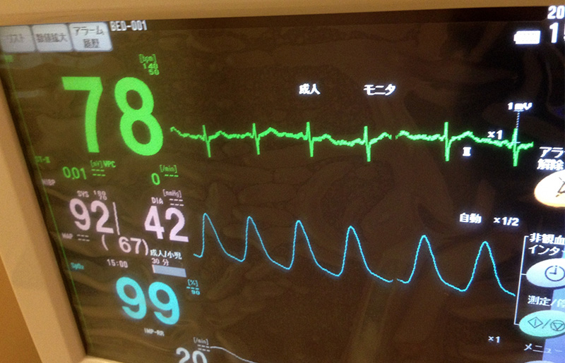 24時間ホルター心電図